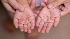HFMD Cases Rising Among the Young Children in Pune